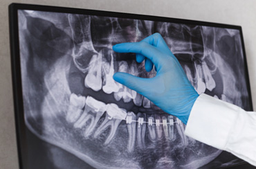 Prosthodontists are experts in dental prosthetics like dental implants, dentures, and dental crowns