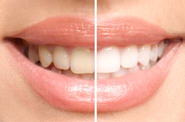 Before and after of teeth whitening in Northampton