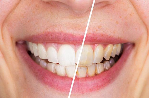 Image before and after teeth whitening in Longmeadow and Northampton
