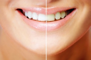 tooth whitening
