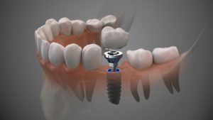 dental implant 3D illustration 