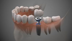dental implant 3D illustration