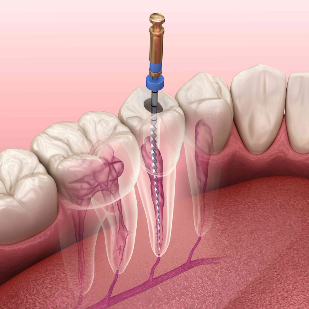 Root canal illustration