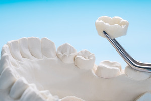 Lifting dental crown off mold of teeth