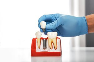 Gloved hand placing a crown on a model of a dental implant